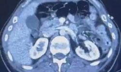 Ülkeye midelerinde uyuşturucu getiren şahıslar yakalandı