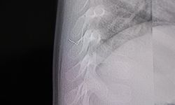 Bebeğin sırtından tel parçası çıktı