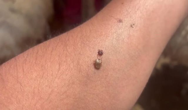 Artan kene vakaları alarm veriyor: Yaşlılar ve çocuklar tehlikede