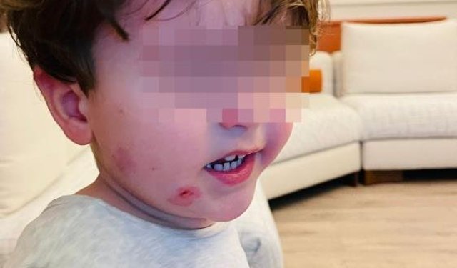 Kreşe bıraktığı çocuğunu darp edilmiş halde aldı